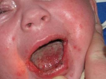 التهاب الفم في الأطفال حديثي الولادة
