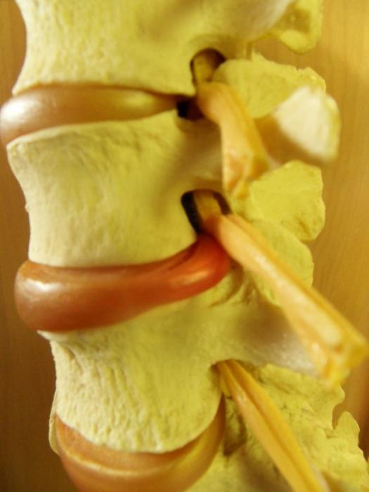 علاج فتق القرص الفقري