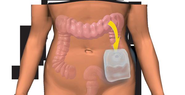 كولوستوما - ما هو؟ فغر القولون: الرعاية بعد العملية الجراحية
