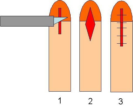 القلفة البلاستيكية frenulum