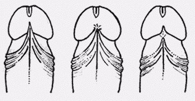 إزالة من frenulum